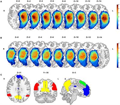 Synergistic structural and functional alterations in the medial prefrontal cortex of patients with high-grade gliomas infiltrating the thalamus and the basal ganglia